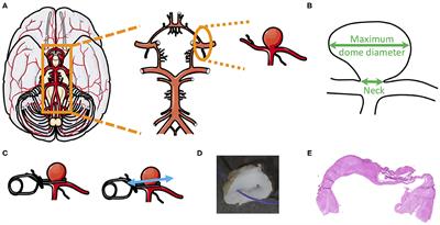 Effect of Aneurysm and Patient Characteristics on Intracranial Aneurysm Wall Thickness